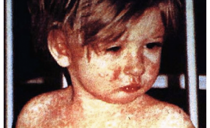 Measles